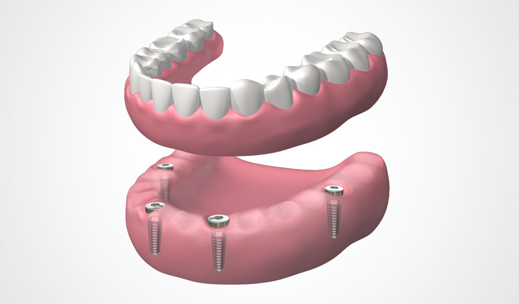 implants dentals Lleida